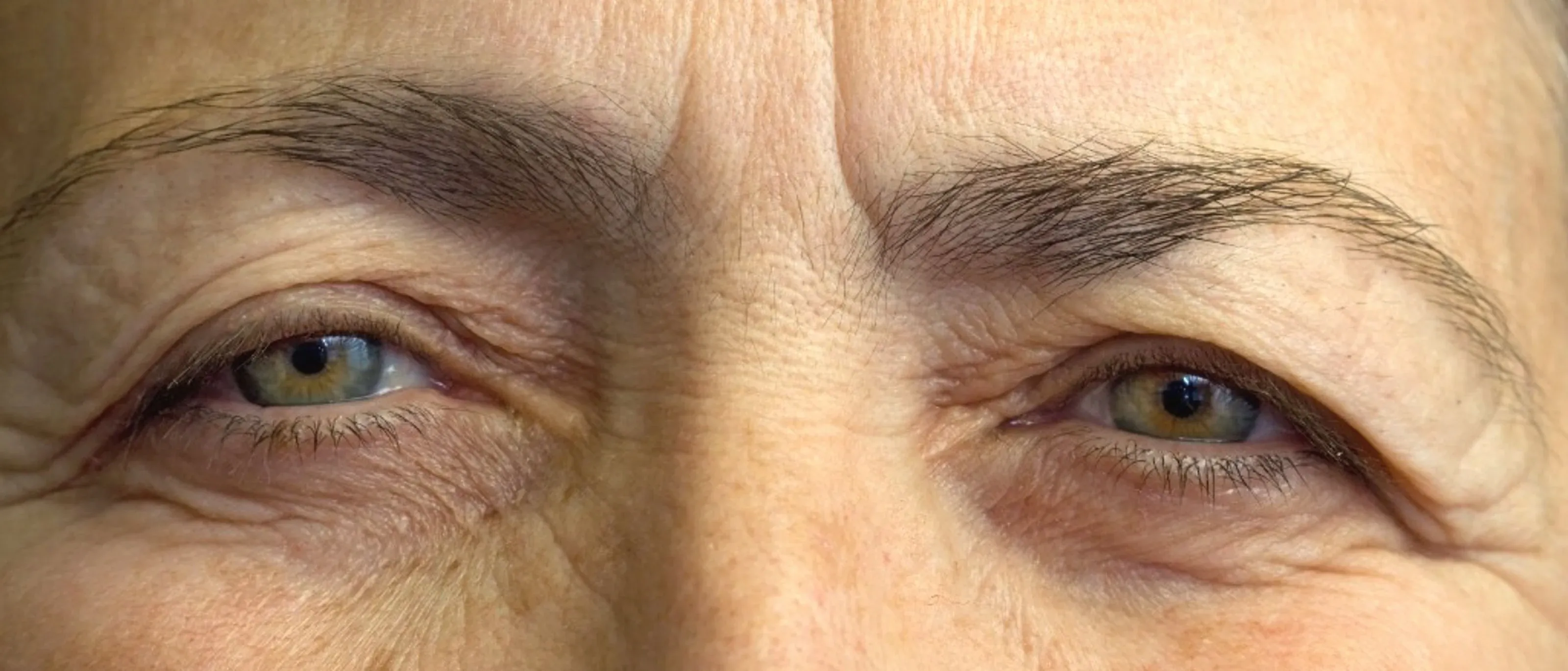 Wide close-up of a mature patient's eyes and forehead showing excess upper eyelid skin and periocular ageing (stock illustration).
