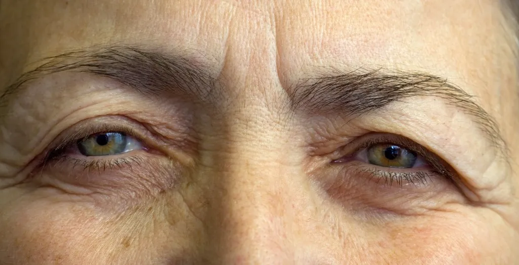 Heavy upper eyelids, with excess skin folding over the lashes and the lid margins sitting low.
