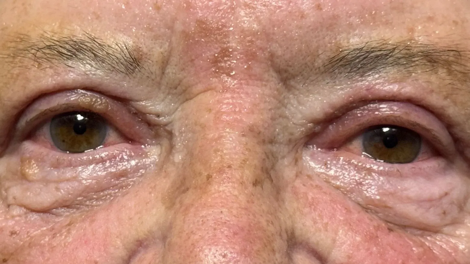 Two weeks after bilateral upper eyelid blepharoplasty: a defined lid crease with the eyelid platform visible, the outer hooding relieved, and a small amount of residual swelling still present.