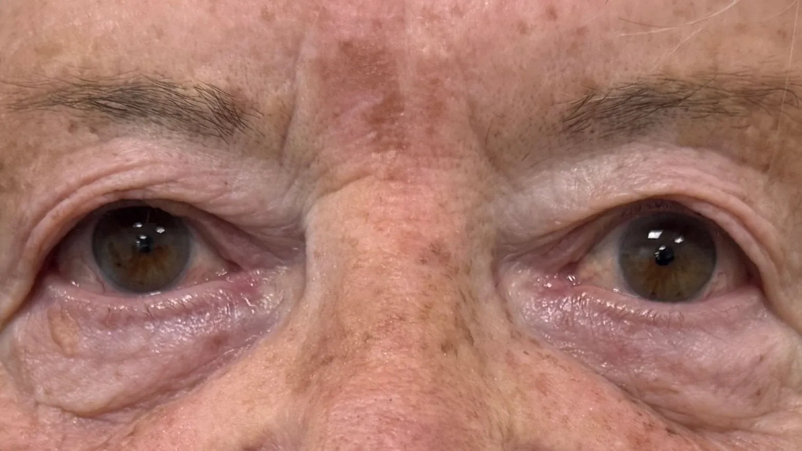 Pre-operative photograph of both upper eyelids: excess skin resting close to the lashes, with hooding at the outer corners and the lid crease obscured.