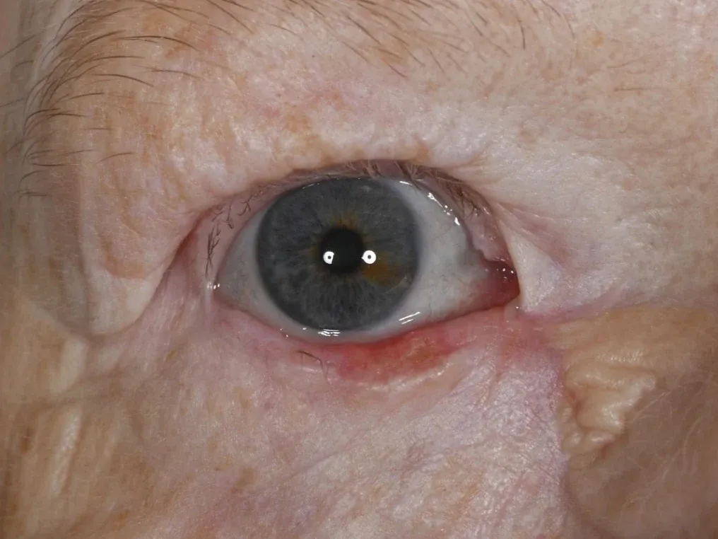 Basal cell carcinoma of the right lower eyelid margin. The margin is red and thickened along its inner half, the lashes are sparse where it is involved, and the eye is otherwise healthy.