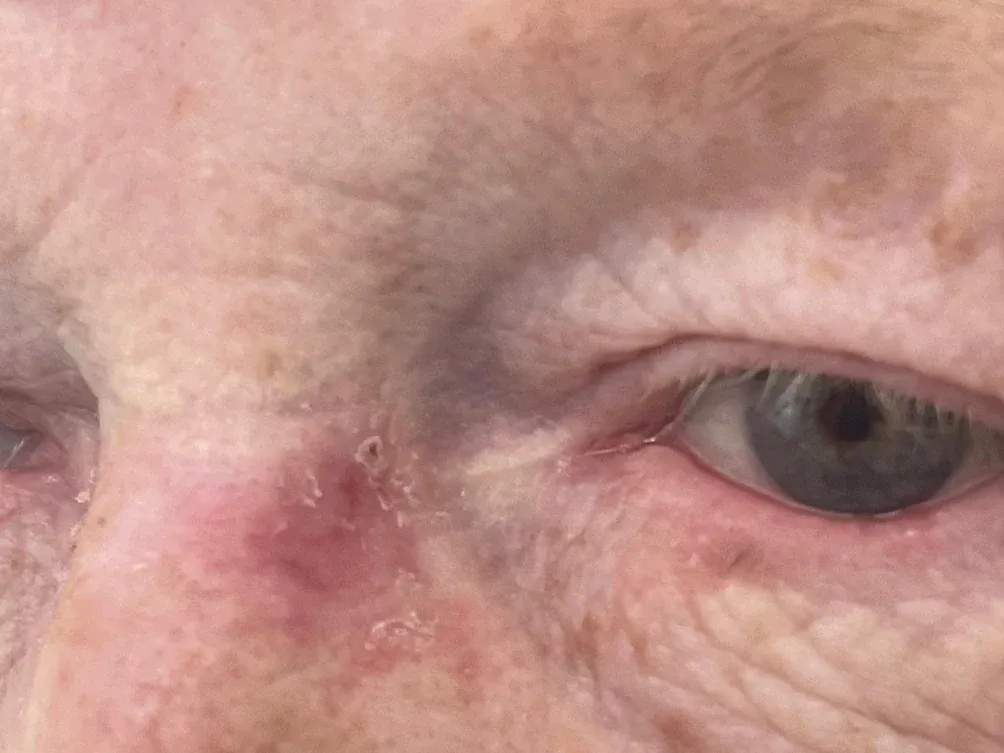 Basal cell carcinoma at the inner corner of the left eye. A dull red, faintly scaly patch on the side of the nose, with light crusting at its surface. It looks like a patch of eczema.