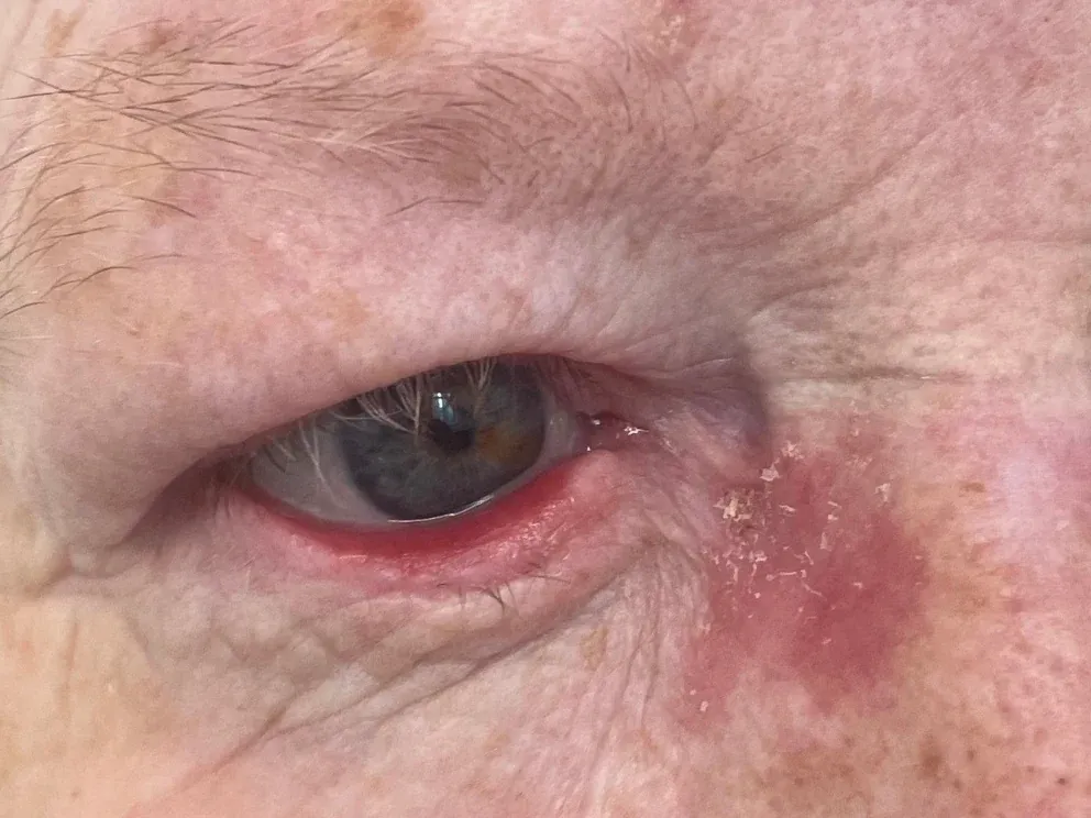Basal cell carcinoma at the inner corner of the right eye. A red, dry, crusted patch immediately beside the inner corner, with a second area of pink, sun damaged skin further out on the cheek.