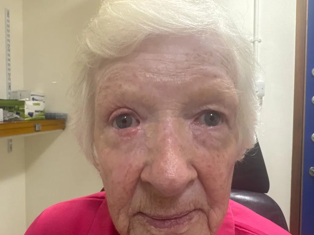 Full face view of the same patient after three periocular reconstructions. At normal conversational distance the two settled grafts at the inner corners and the three month old lower eyelid reconstruction are difficult to pick out at all.