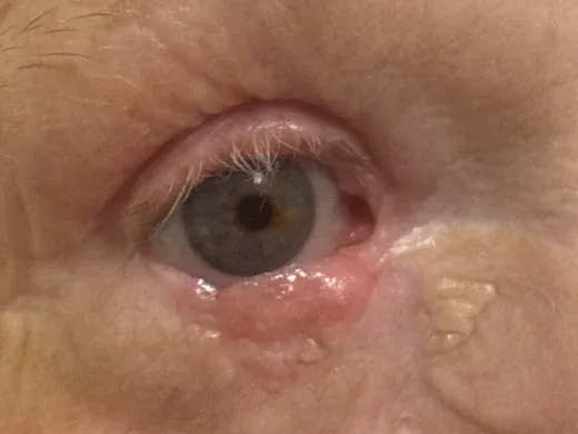 The right lower eyelid three months after Hughes tarsoconjunctival flap reconstruction with an upper eyelid skin graft. The rebuilt lid sits in the correct position against the eye and the grafted skin is still pink and slightly thickened.