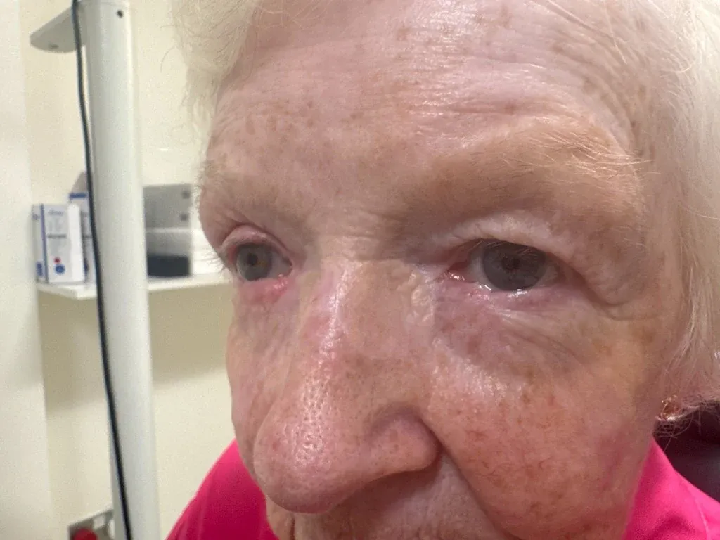 Both inner corners two years and two and a half years after full thickness skin grafts. The grafted skin is pale, flat and thin, and blends into the surrounding skin closely enough that the edges of the grafts are difficult to find.