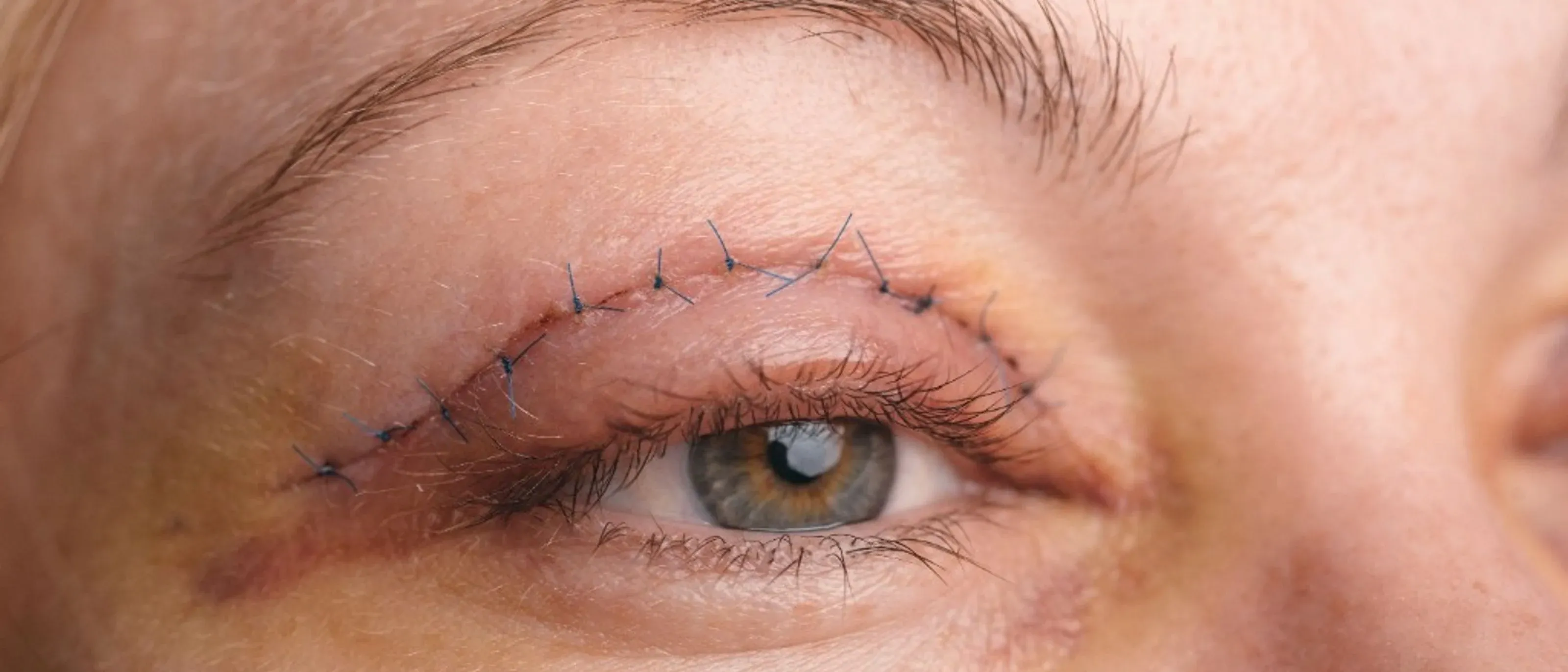 Close-up of the right eye after upper blepharoplasty and ptosis repair, with sutures along the lid crease and early bruising (stock photograph).