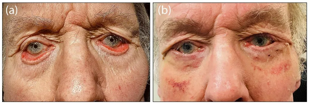 Bilateral tarsal ectropion before and after surgery. (a) Immediately before the operation, after a two-week course of topical steroid ointment, the lower eyelids are turned outward with the pink conjunctival lining exposed and the midface descended. (b) Two weeks after surgery, the eyelids have returned to their normal position.